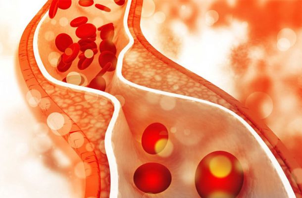 20201021mot so dau hieu roi loan lipid mau thuong gap nhat 17301186045971100879049