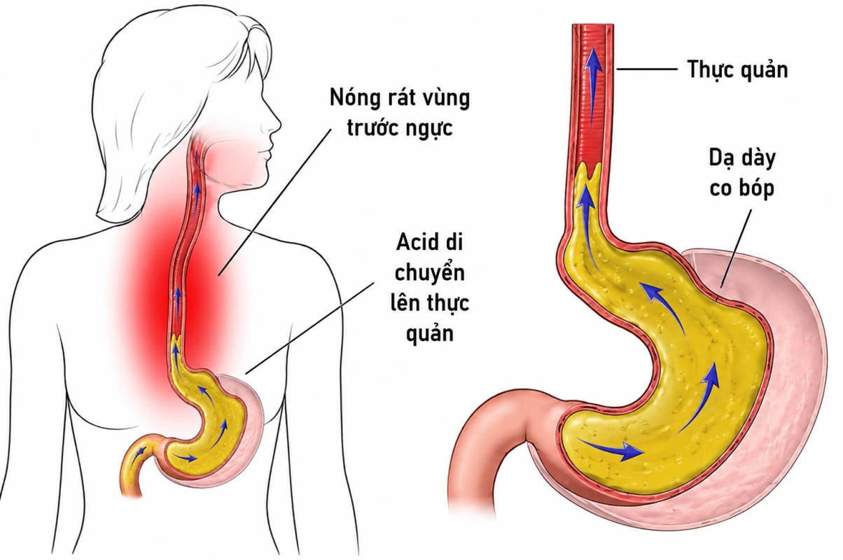 Hệ lụy khi lạm dụng thuốc giảm tiết acid ở người trào ngược dạ dày