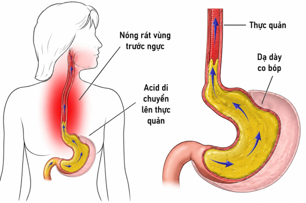 Hệ lụy khi lạm dụng thuốc giảm tiết acid ở người trào ngược dạ dày